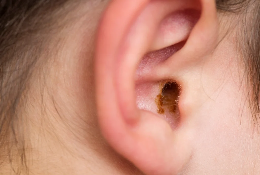 Calder Ear Care - Professional Ear Cleaning Services in Calderdale - 03